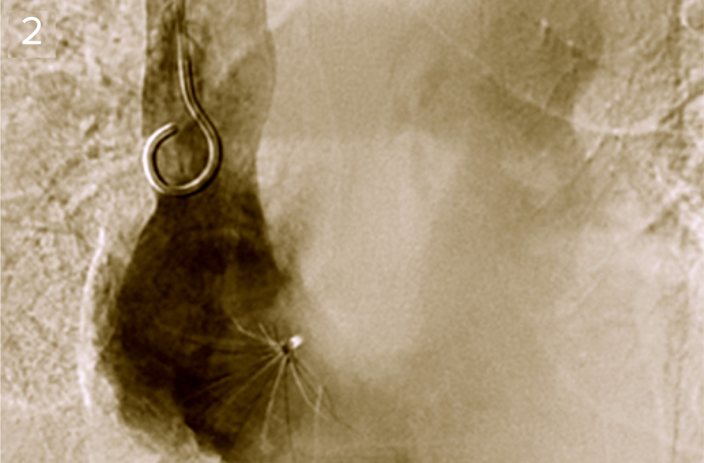 An IVC filter lodged in the right atrium of the heart